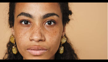 PCOS & Hyperpigmentation: Causes, Treatments & Skincare Tips