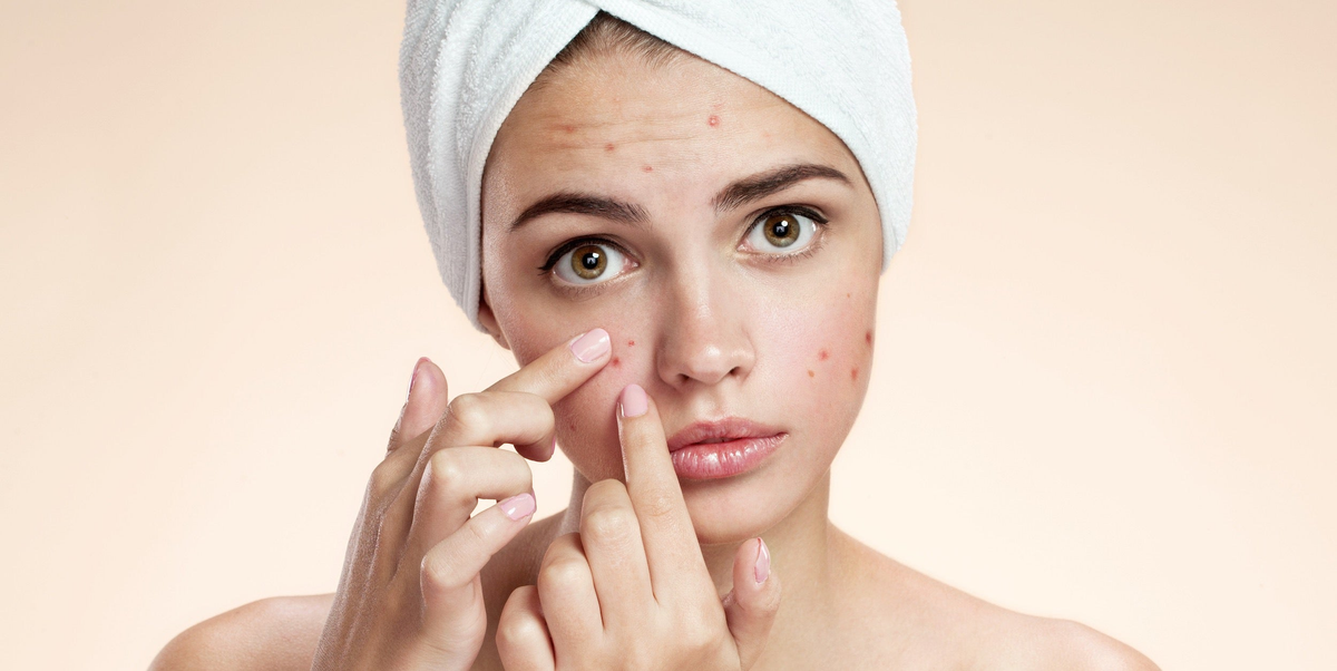 5 Tips For Managing PCOS Induced Hormonal Acne