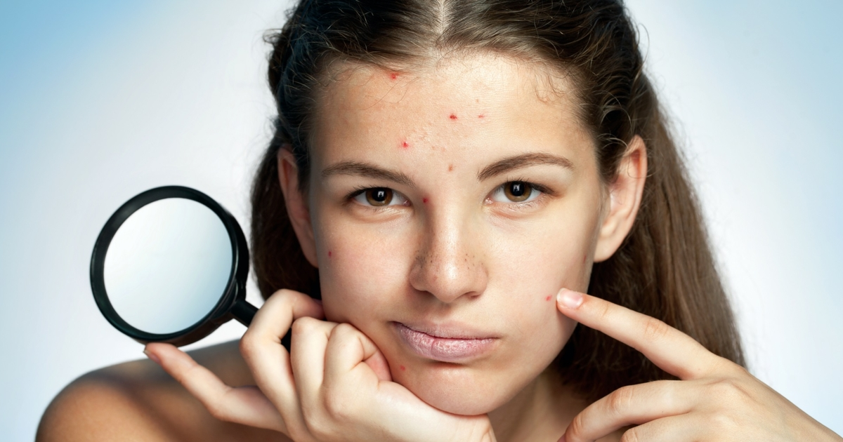Spots, Dry, and Oily Skin: How Hormones Affect Your ...
