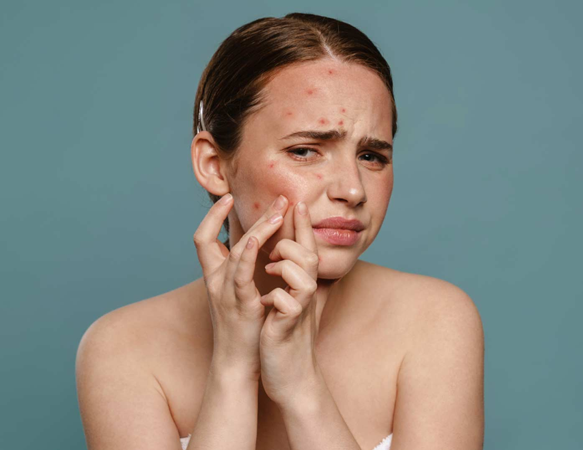 Hormonal Acne: How Hormones Play A Role in Breakouts