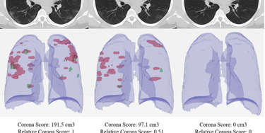 OpenGraph image for spectrum.ieee.org/the-human-os/biomedical/imaging/hospitals-deploy-ai-tools-detect-covid19-chest-scans