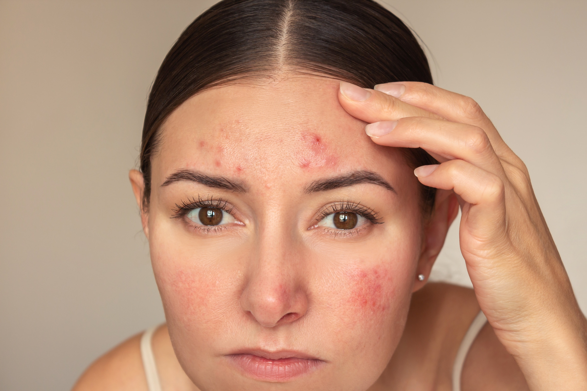 How Stress Affects Your Skin | Dermatologists in Cook County, IL