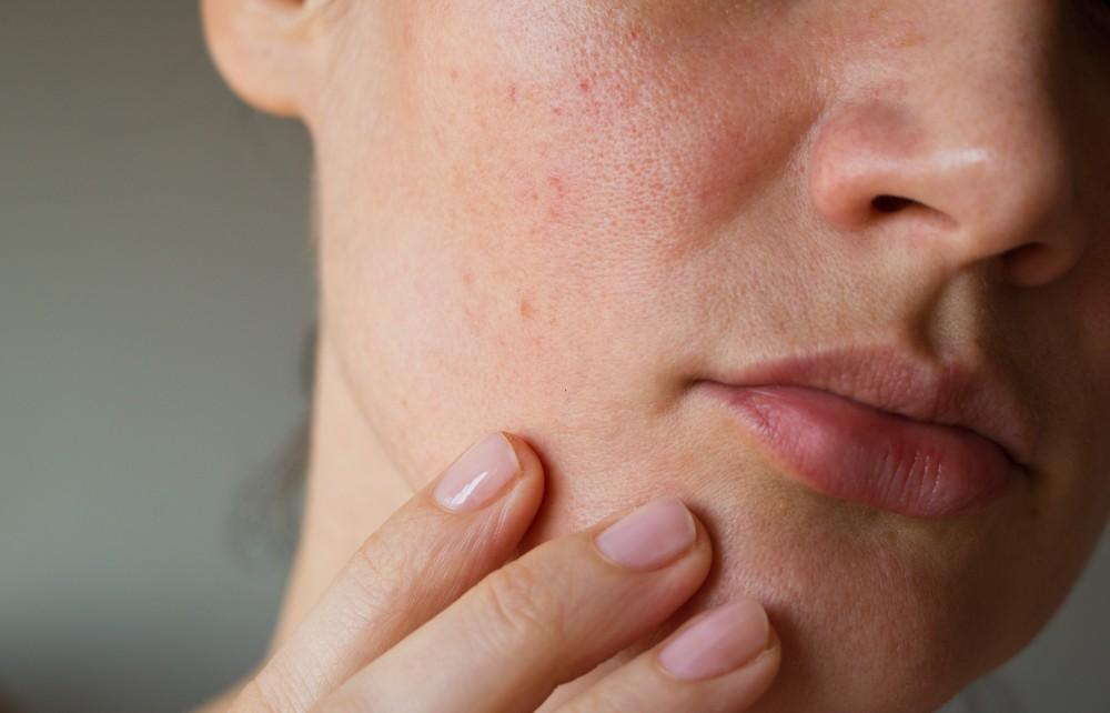 How PCOS Affects Your Skin (and What To Do About It)