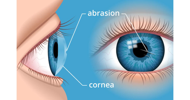OpenGraph image for allaboutvision.com/conditions/corneal-abrasion.htm