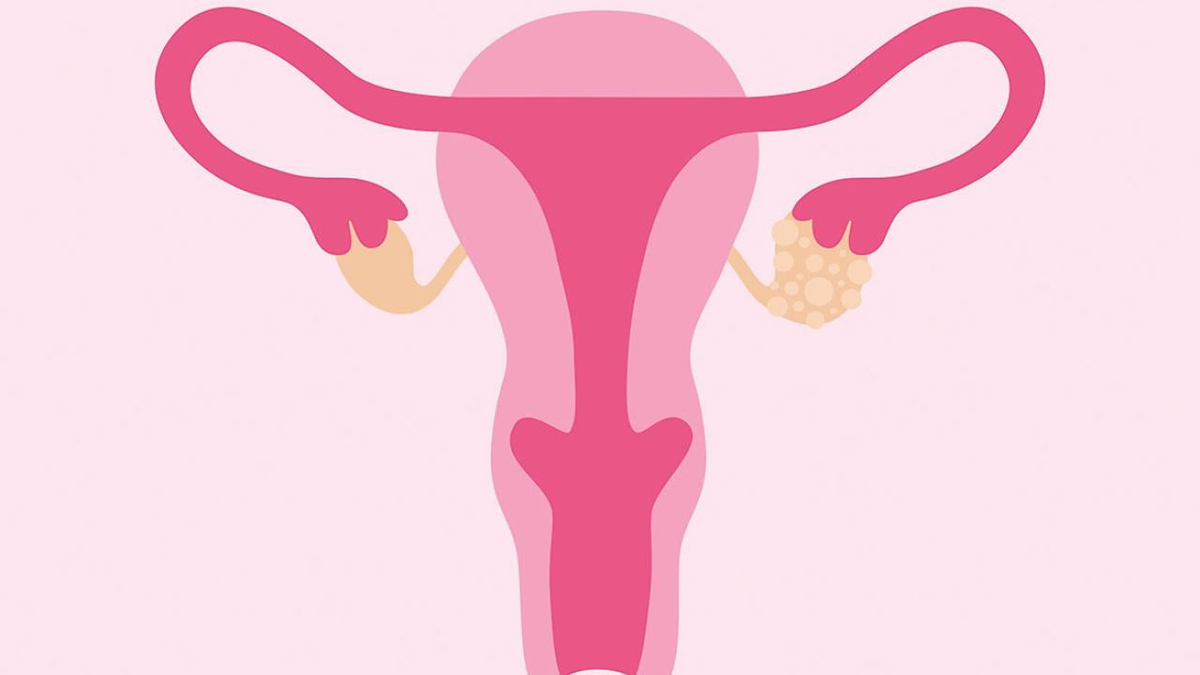 What doctors wish patients knew about polycystic ovary syndrome