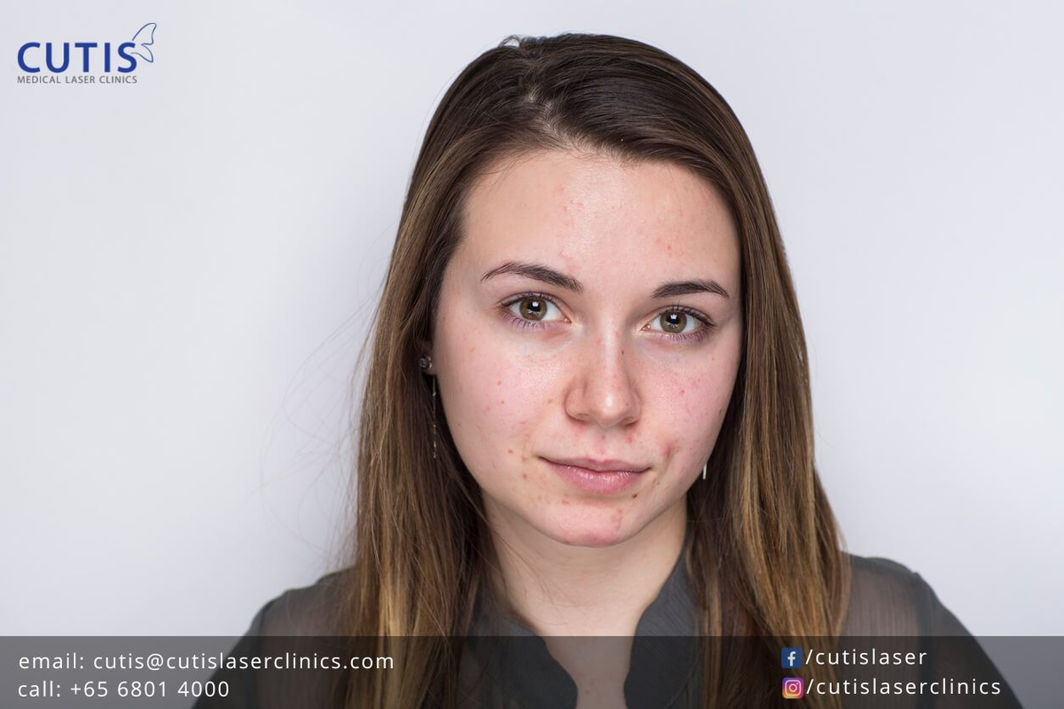 What Happens to Your Skin During Your Menstrual Cycle