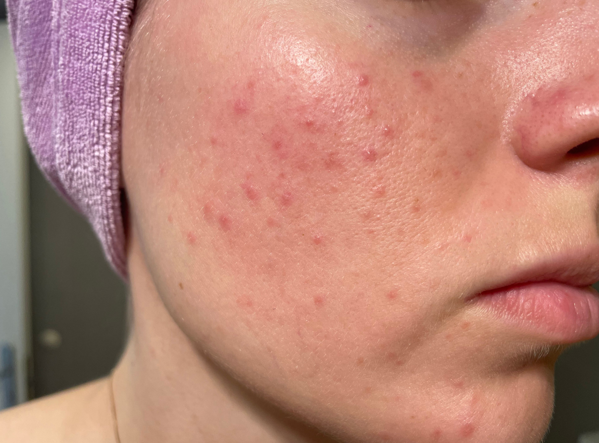 Acne Burden is Growing in Young Women Across the World, New ...