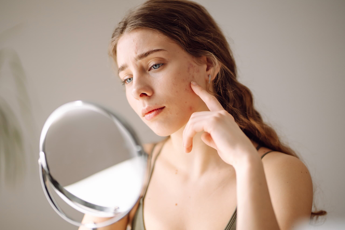 Hormonal Acne Causes and Treatments