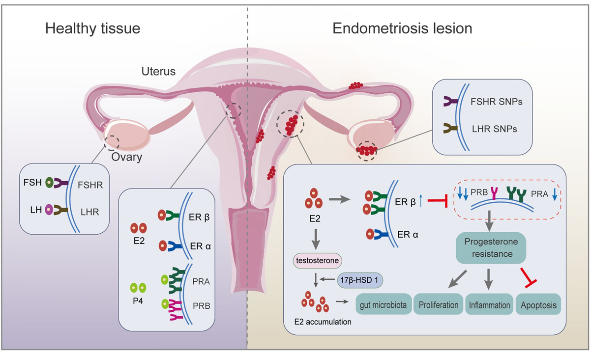 Update on the pathogenesis of endometriosis-related infertility ...
