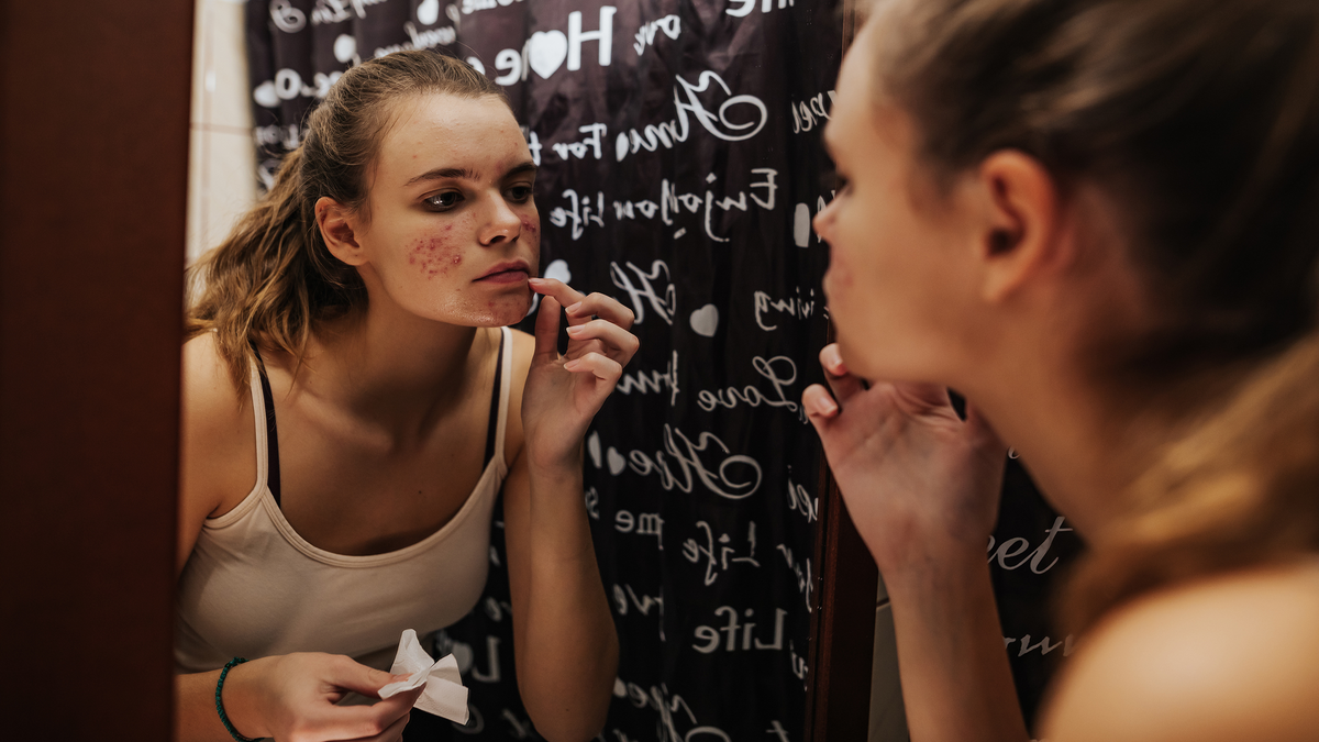 What Does Hormonal Acne Look Like? Images, Signs, and Treatment