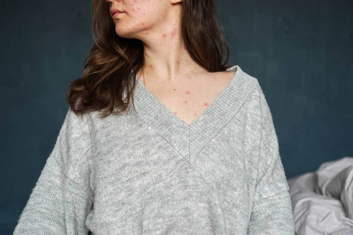 Acne During Ovulation? Why It Happens & How To Fix It