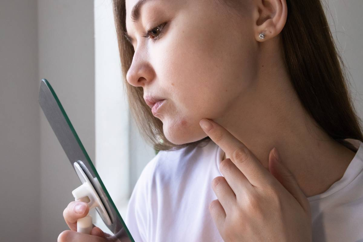 Hormonal Acne: How Your Menstrual Cycle Affects Your Skin