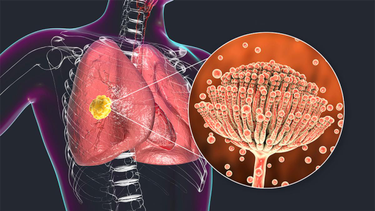 OpenGraph image for srlf.org/article/infections-fongiques-invasives-covid-19