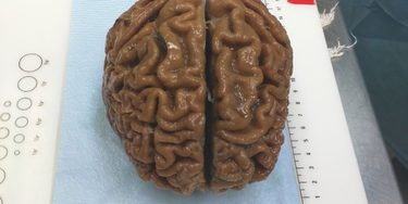 OpenGraph image for technologyreview.com/s/610456/a-startup-is-pitching-a-mind-uploading-service-that-is-100-percent-fatal/amp/