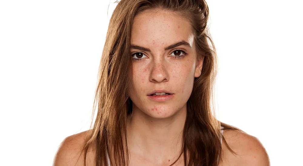 The Melasma PCOS Connection | Victorian Dermal Group