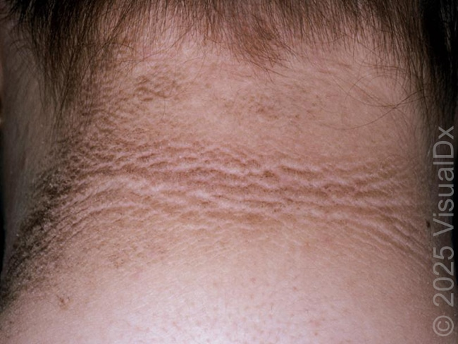 Cutaneous Manifestations of Polycystic Ovarian Syndrome (PCOS)