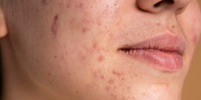 Top 7 effective Treatment Tips for Managing PCOS-Related Acne